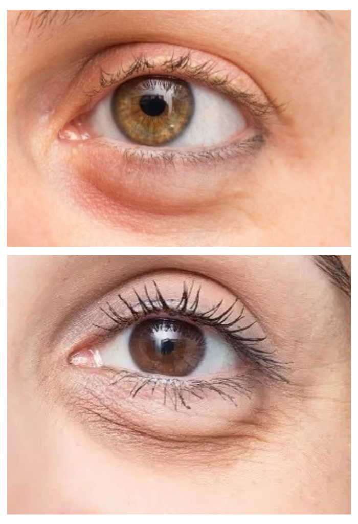  Antes